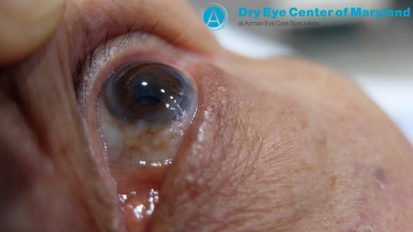 close up of a person's eye and cornea, chronic dry eye and red eyes. having Amniotic Membrane Prokera Baltimore Dry Eye Treatment