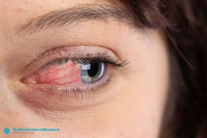 The Best Ocular Rosacea Treatment | Dry Eye Center