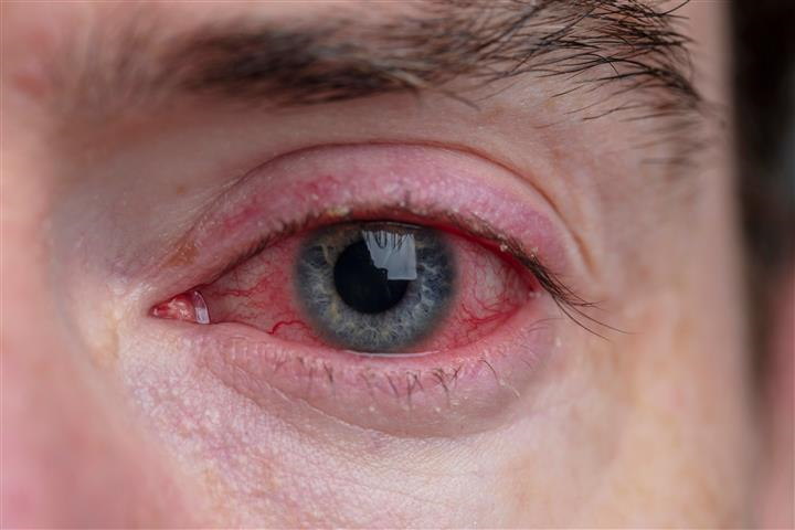 red eye due to OCULAR SURFACE DISEASE (OSD) untreated