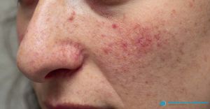 Close,Up,View,Of,Young,Caucasian,Girl,Face,Suffering,From Rosacea, with ipl treatment, Baltimore, md