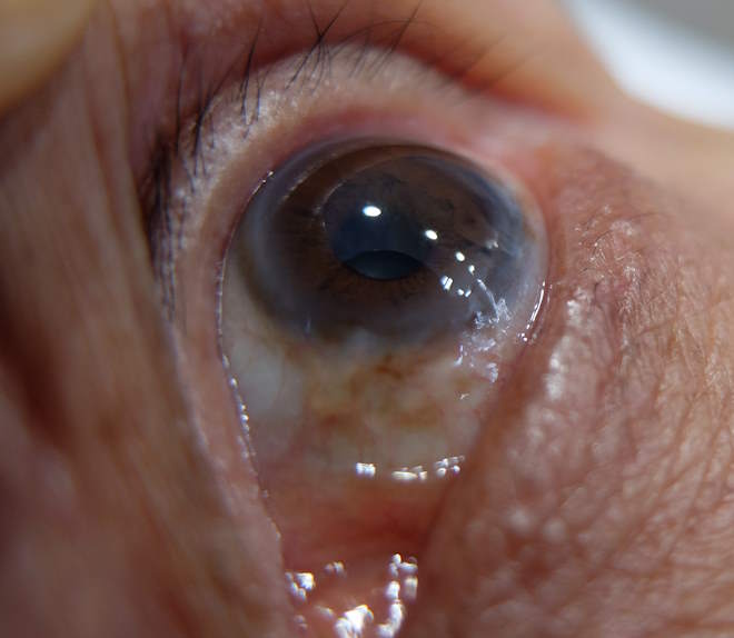 damaged cornea being treated with Amniotic Membrane Prokera in Baltimore