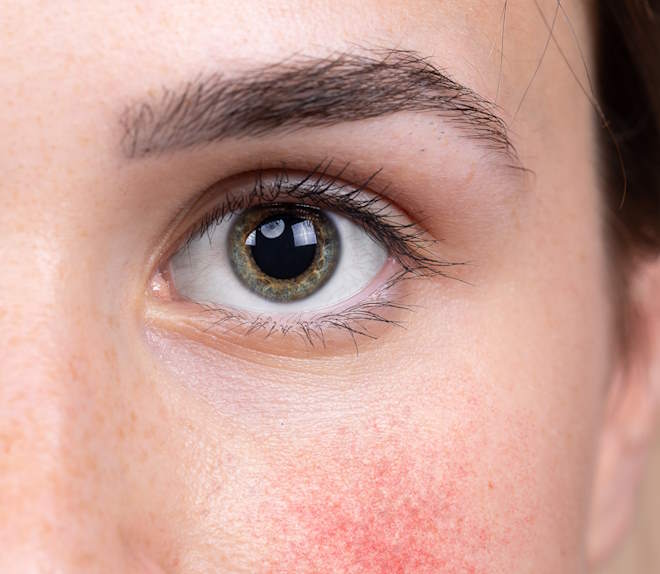 woman with OCULAR-ROSACEA who needs Treatment in baltimore