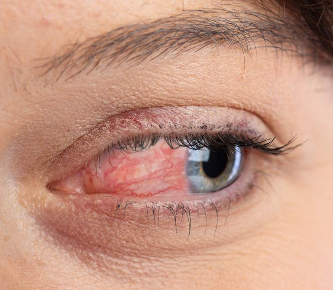 woman's eye with Ocular Surface Disease in Baltimore, Maryland