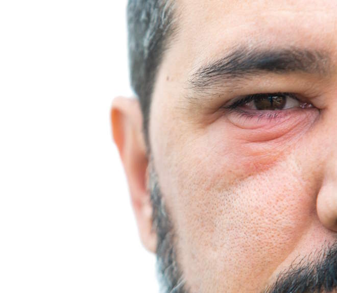 blepharitis-eye-treatments-baltimore