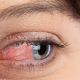 ocular aesthetics red eye treatment