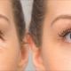 ocular aesthetics treatments before-after