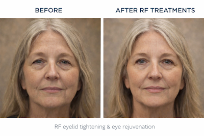 Before and after RF eyelid tightening treatment showing improved skin firmness and eye rejuvenation at Dry Eye Center of Maryland